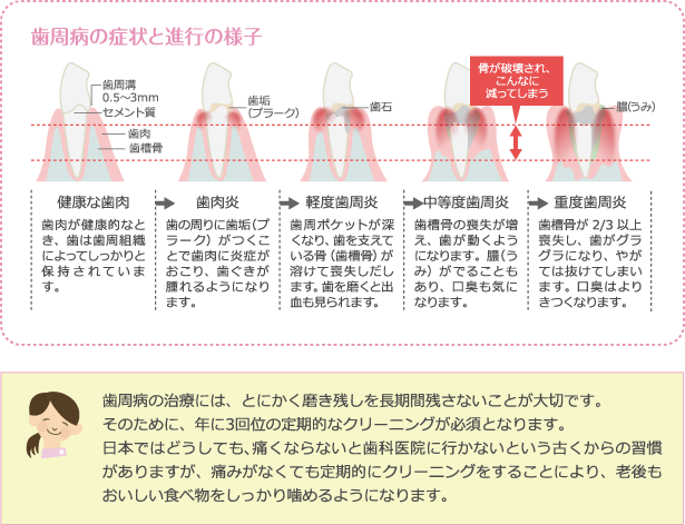 歯周病の症状と進行の様子