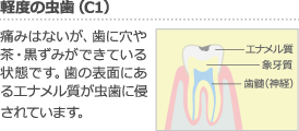 軽度の虫歯