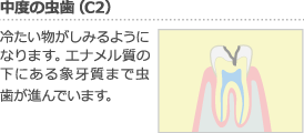 中度の虫歯