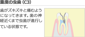 重度の虫歯