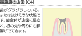 最重度の虫歯