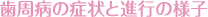 歯周病の症状と進行の様子
